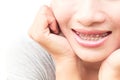 Close up woman smiling with Ceramic and Metal Braces on white ba Royalty Free Stock Photo