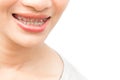 Close up woman smiling with Ceramic and Metal Braces on white ba Royalty Free Stock Photo