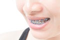 Close up woman smiling with Ceramic and Metal Braces on white ba Royalty Free Stock Photo