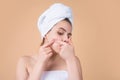 Close up Woman squeeze out pimples on cheek. Acne and pimple on skin. Dermatology, puberty woman. Pimples problem skin Royalty Free Stock Photo
