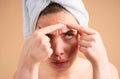 Close up woman squeezing pimples on her face. Acne blemish spots skin on young woman. Spot scar acne, freckles, and Royalty Free Stock Photo