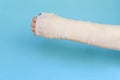 Woman with broken arm bone in cast, plastered hand on blue background. Royalty Free Stock Photo