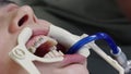 Close up of woman's mouth wearing dental retractor in dentistry clinic. Orthodontic correction of malocclusion with