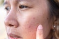 Close up of women freckle, dark spot on face, dried skin issues, need treatment. Asian middle age women Royalty Free Stock Photo