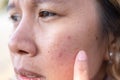 Close up of women freckle, dark spot on face, dried skin issues, need treatment. Asian middle age women