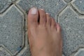 Close up of women`s foot on a concrete floor background. Foot is ugly, dark brown and it has hair and veins showing. No