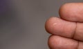 close up of wooden splinter in a man's finger Royalty Free Stock Photo