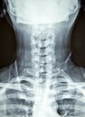 Close up x-ray film show cervical spine or c-spine, neck bones x-ray film. Royalty Free Stock Photo