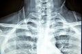 Close up x-ray film show cervical spine or c-spine, neck bones x-ray film. Royalty Free Stock Photo