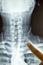 Close up x-ray film show cervical spine or c-spine, neck bones x-ray film. Royalty Free Stock Photo