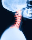 Xray of the cervical spine painful