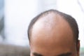 Close up young man concerned with serious hair loss. bald head thin and scalp and broken hair. concept healthcare. Royalty Free Stock Photo