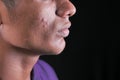Close up of young man face with skin problem . Royalty Free Stock Photo
