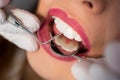 Close up of young woman having dental check up in dental office. Dentist examining a patient`s teeth with dental tools