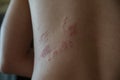 Close up on zoster disease on human skin