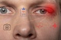 Close the upper left eyelid abscess. Eye with barley Royalty Free Stock Photo