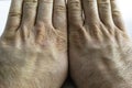 Close view of dry and cracked hand knuckles, skin problem