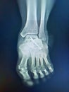Close up X-ray foot post operation screws.Medical concept. Royalty Free Stock Photo
