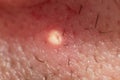 Acne pus, Close up photo of acne prone skin