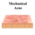 Closed comedones. Acne on the skin. Dermatological and cosmetic diseases on the skin of the face acne. Infographics