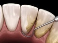 Closed curettage: Scaling and root planing conventional periodontal therapy. Medically accurate 3D illustration of human teeth