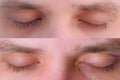 Man eyes before and after laser removal of papillomas on eyelids skin growths.