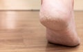 Closed-up of cracked heels, also known as fissures, a common foot problem Royalty Free Stock Photo