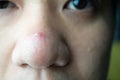 Closed-up many blackhead pimples and acne scars on the nose of an Asian skin face