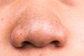 Closed-up of pimple blackheads on the nose Royalty Free Stock Photo
