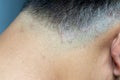 Closed up of ringworm tinea on head of asian man Royalty Free Stock Photo