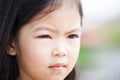 Closeup of asian child girl eye swell from bacteria Royalty Free Stock Photo