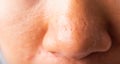 Woman large pores have freckles cheek oily, acne pimple on nose