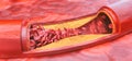 Closeup of a atherosclerosis- 3D rendering