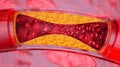 Closeup of a atherosclerosis- 3D rendering