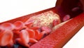 Closeup of a atherosclerosis- 3D rendering