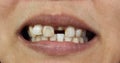 Closeup of bad teeth Royalty Free Stock Photo