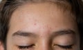 Closeup on the blemished skin with acne of a young caucasian teenage boy