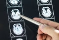 Closeup of brain MRI scan result medical concept