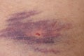 Closeup of bruise over white skin