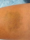 Closeup bruise on skin of person is blue yellow in color