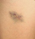 Closeup Bruise on wounded woman's leg skin