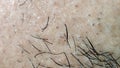 Closeup of caucasian skin with ingrown hair and man short beard. Close up of caucasian skin with many ingrown hairs concept Royalty Free Stock Photo