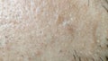 Closeup of caucasian skin with ingrown hair and man short beard. Close up of caucasian skin with many ingrown hairs concept Royalty Free Stock Photo