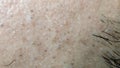 Closeup of caucasian skin with ingrown hair and man short beard. Close up of caucasian skin with many ingrown hairs concept Royalty Free Stock Photo