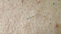 Closeup of caucasian skin with ingrown hair and man short beard. Close up of caucasian skin with many ingrown hairs concept Royalty Free Stock Photo