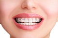 Closeup Ceramic and Metal Braces on Teeth. Beautiful Female Smile with Self-ligating Braces. Orthodontic Treatment... Royalty Free Stock Photo