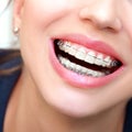Closeup Ceramic and Metal Braces on Teeth. Beautiful Female Smil Royalty Free Stock Photo