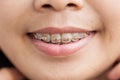 Closeup Ceramic and Metal Braces on Teeth Royalty Free Stock Photo