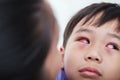 Closeup of chronic conjunctivitis with a red iris.