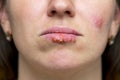 Closeup of a common cold sore virus herpes. Part of a young woman`s face with a virus herpes on lips